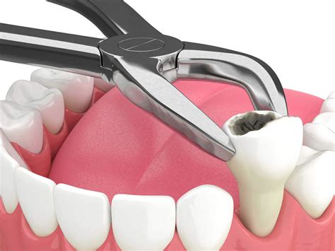 cheapest place to get a tooth pulled burnsville area